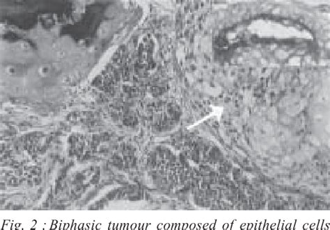 Pdf Malignant Mixed Tumour Of Cutaneous Origin A Rare Tumour