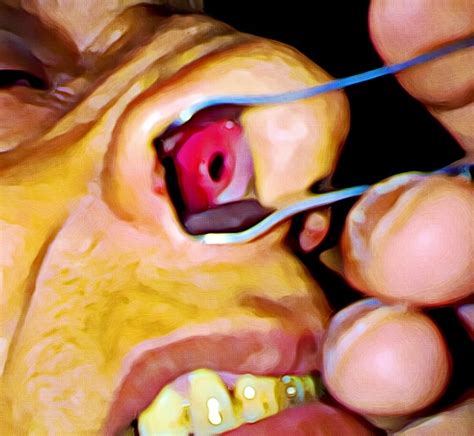 Cocaine Nose: Signs of Nasal Damage from Heavy Coke Use
