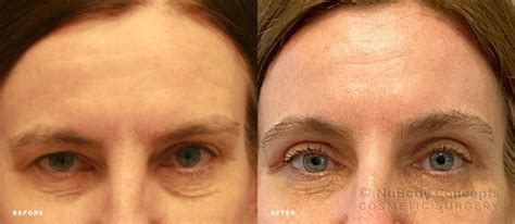 My Eyelid Surgery With Brow Lift From Start To Finish The Recovery NuBody Concepts