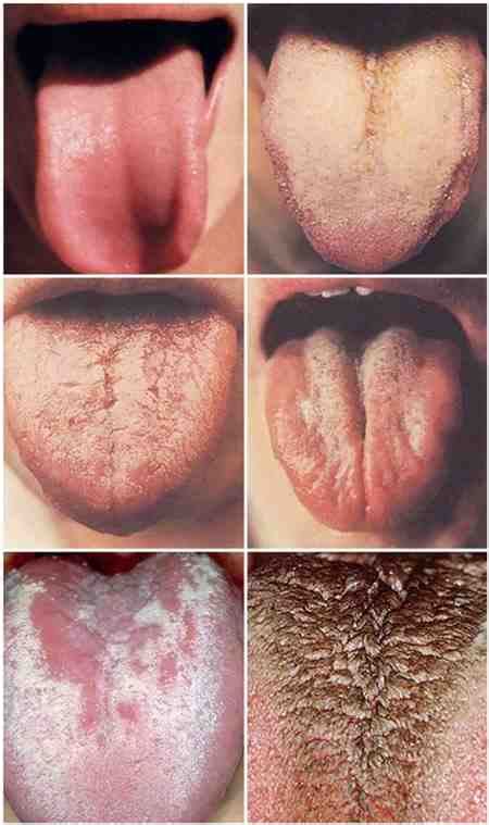 Viral White Spots Throat Sore Throat Drops Nasal Stones For Tonsil V