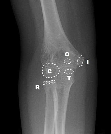 Elbow Ossification Mnemonic Radiology Reference Article