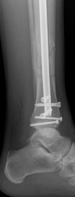 Tibial Shaft Fractures John Riehl Md