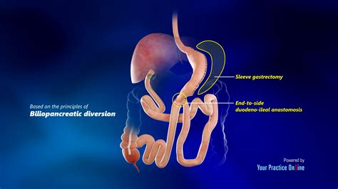 Single Anastomosis Duodeno Ileal Bypass With Sleeve Gastrectomy Sadi S