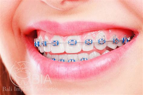 Clear Braces With Colors
