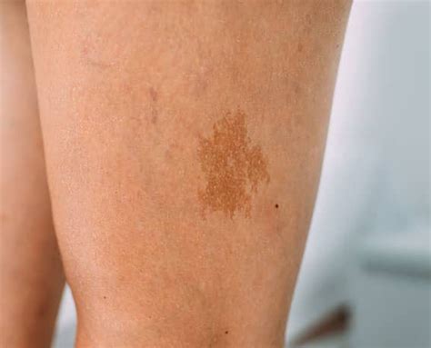 Laser Birthmark Removal Total Body Laser And Med Spa Madison Wisconsin