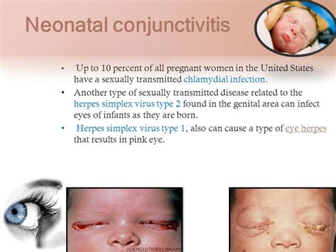 If your pink eye is caused by a bacterial infection, your ophthalmologist may prescribe antibiotic eye drops, depending on how severe your symptoms are. Childhood Diseases - On a Mission to Educate: Pink Eye ...