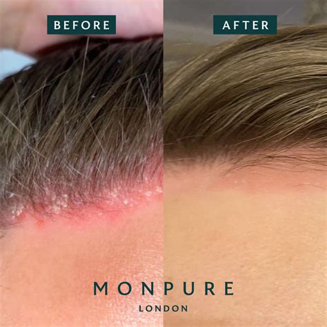 Scalp Psoriasis Before And After James Story Monpure