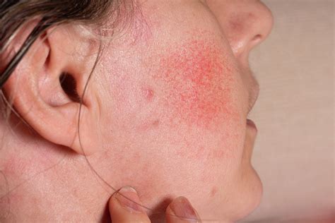 Rosácea O Que é Audioderma Dermatologia Clínica