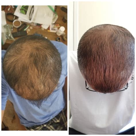 Coat your palms with a thin layer of cbd oil, then apply the oil directly to your scalp. CBD and Hair Growth Follow Up - 2 months of using cbd oil ...