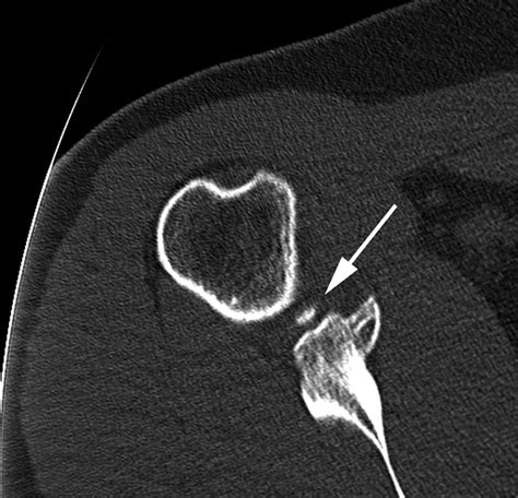 Non Operative Treatment Of Large Anterior Glenoid Rim Fractures After