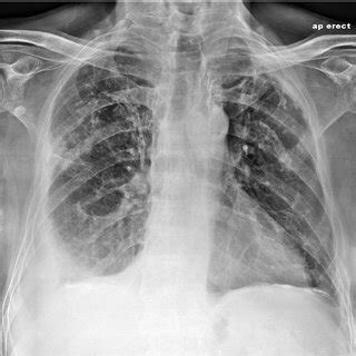 Other causes are complicated parapneumonic effusion. Chest CT scan showing a loculated right-sided pleural effusion with... | Download Scientific Diagram