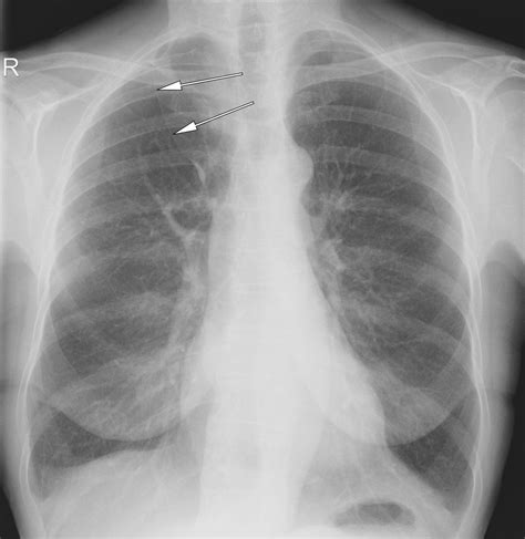 Azygos Fissure As Seen On A Pa Chest Radiograph Normal Variant