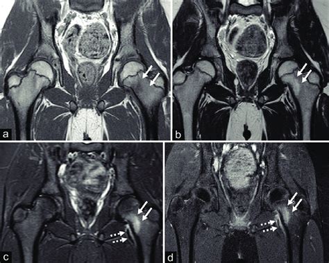 Coronal Magnetic Resonance Imaging Images Of Bilateral Hips Obtained