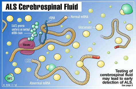 Als (amyotrophic lateral sclerosis) is an incurable condition that can cause symptoms such as muscle weakness, atrophy of muscles, and spasticity, among other things. ALS is becoming more and more common-and it starts with ...