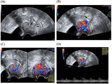 updated applications of ultrasound in uterine cervical cancer