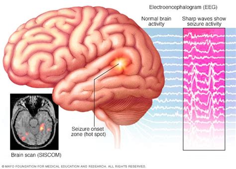 Epilepsy Mayo Clinic