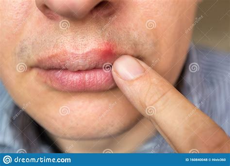 Para el tratamiento del herpes zoster se usan diferentes tipos de medicamentos. Red Inflammation And Herpes Zoster Virus On Upper Male Lip ...