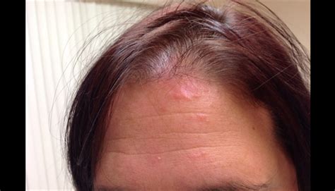 Derm Dx Erythematous Patches And Plaques On A Womans Forehead