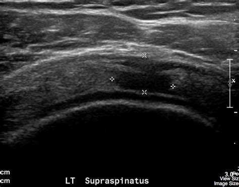 Rotator Cuff Undergraduate Diagnostic Imaging Fundamentals