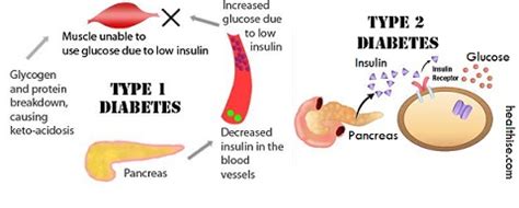 Chronic hyperglycemia of diabetes can lead to multiorgan damage, resulting in renal, neurologic, cardiovascular. Diabetes Mellitus - Healthise.com™