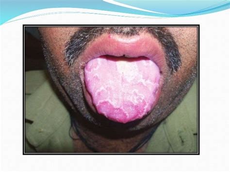 Diseases Of Tongue
