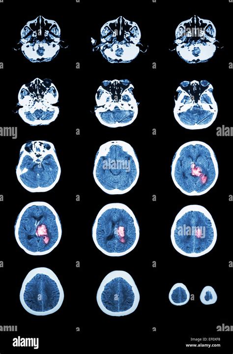 Hemorrhagic Stroke Ct Scan Computed Tomography Of Brain