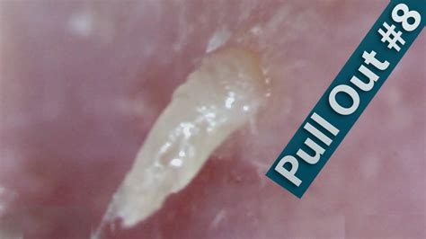 08 Pull Out Blackheads Close Up Blackheads Removal Youtube