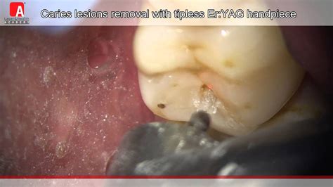 Caries Removal And Cavity Preperation With Fotona Lightwalker Eryag