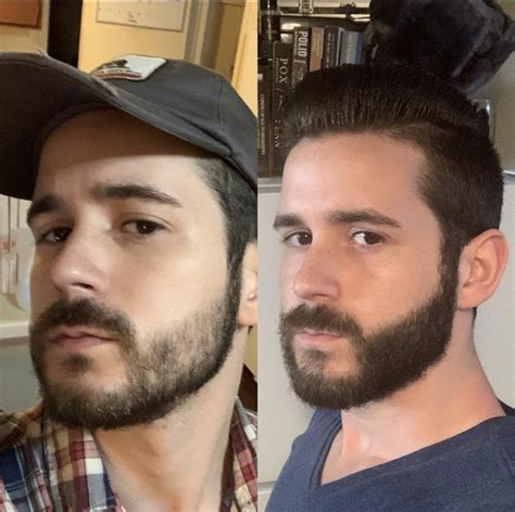 The population of people using minoxidil to enhance beard skyrocketed in recent years. Minoxidil Before And After Beard Result : Minoxidil Beard Growth Journey Before And After 2018 ...