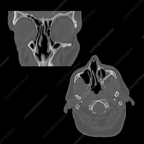 Ct Of Nasal Septum Stock Image M3720361 Science Photo Library