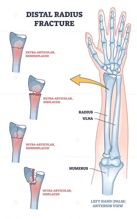 Distal Radius Fracture And Broken Arm Bone Types Anatomy Outline