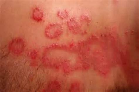 Candida Rashes Is Your Yeast Rash Caused By Yeast Imbalance On Skin
