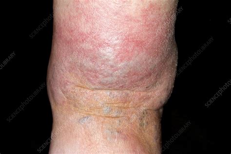 Cellulitis Affecting The Ankle Stock Image C0213291 Science