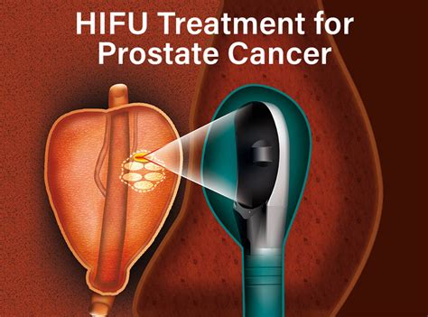Prostate Cancer Treatment TULSA PRO HIFU SoCal Urology