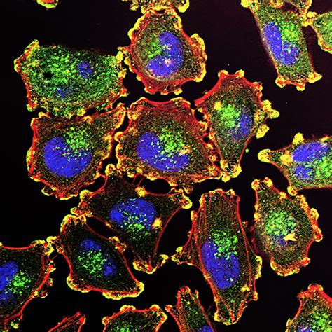 Superficial spreading melanoma, nodular melanoma, lentigo maligna melanoma and acral lentiginous melanoma. TCGA study of genetic drivers of melanoma - National ...