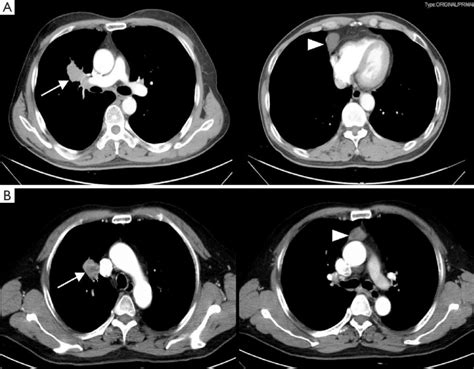 The Chest Ct Images Of Two Patients A The Enhanced Chest Ct Images