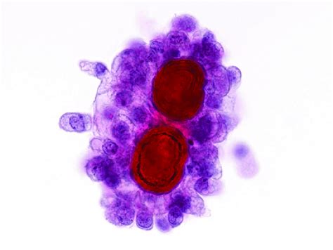 Such bodies occur in both benign and malignant epithelial and connective tissue. 13 Papillary thyroid carcinoma. Psammoma bodies are ...