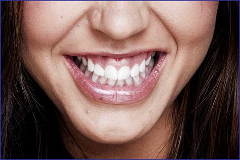 Gum Line Contouring For A Shapelier Smile Oris Dental Center