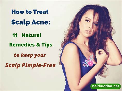 How To Treat Scalp Acne11 Natural Remedies To Keep Your Scalp Pimple