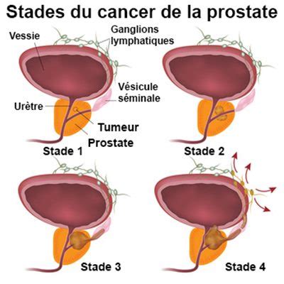 Qu Est Ce Qui Cause Le Cancer De La Prostate CancerWalls