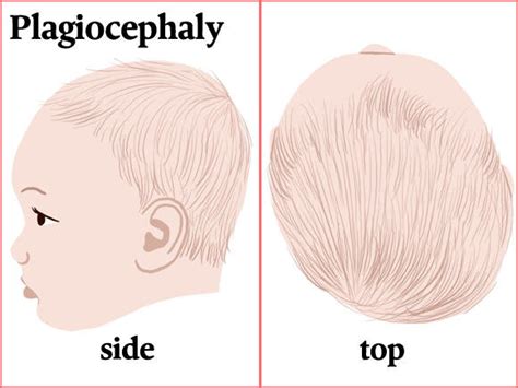 Preventing Plagiocephaly In Your Infant Aka Flat Head Syndrome