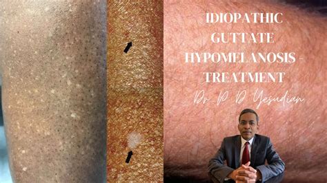 Idiopathic Guttate Hypomelanosis A Review With Emphasis On Treatment