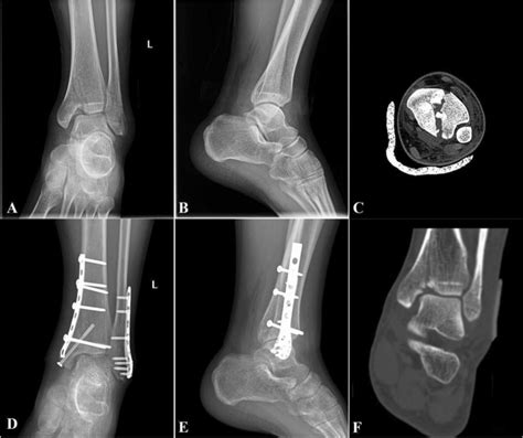 Medial Malleolus Of Tibia