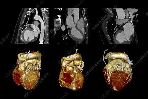 Quadruple Heart Bypass Ct Scans Stock Image C0147077 Science