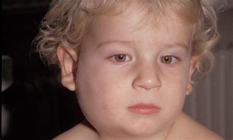 Перевод слова mumps, американское и британское произношение, транскрипция, словосочетания, однокоренные слова, примеры использования. Mumps | Deutsches Grünes Kreuz für Gesundheit e.V.