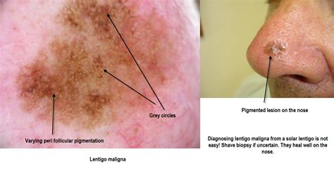 Dermoscopy Made Simple Lentigo Maligna