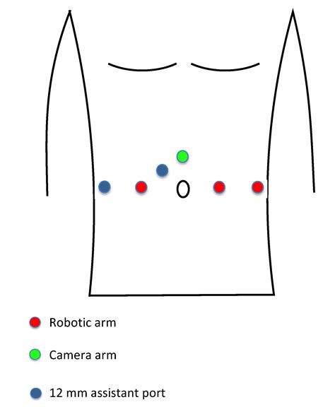 Jcm Free Full Text Robot Assisted Intracorporeal Orthotopic Ileal Neobladder Description Of