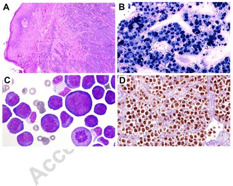 Figure 1 From The Histological Classification Of Diffuse Large B Cell