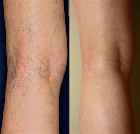 What Is Spider Vein Sclerotherapy Treatment And Recovery