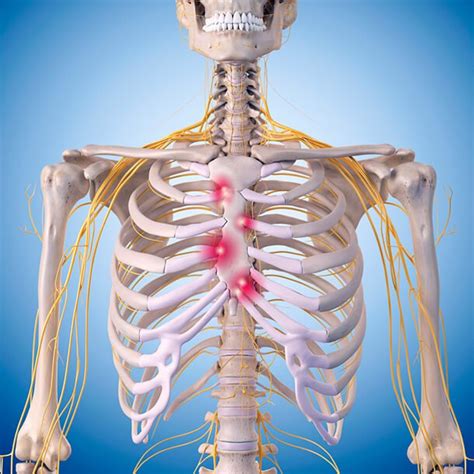 Costochondritis What It Is And What We Can Do About It Kate Straus